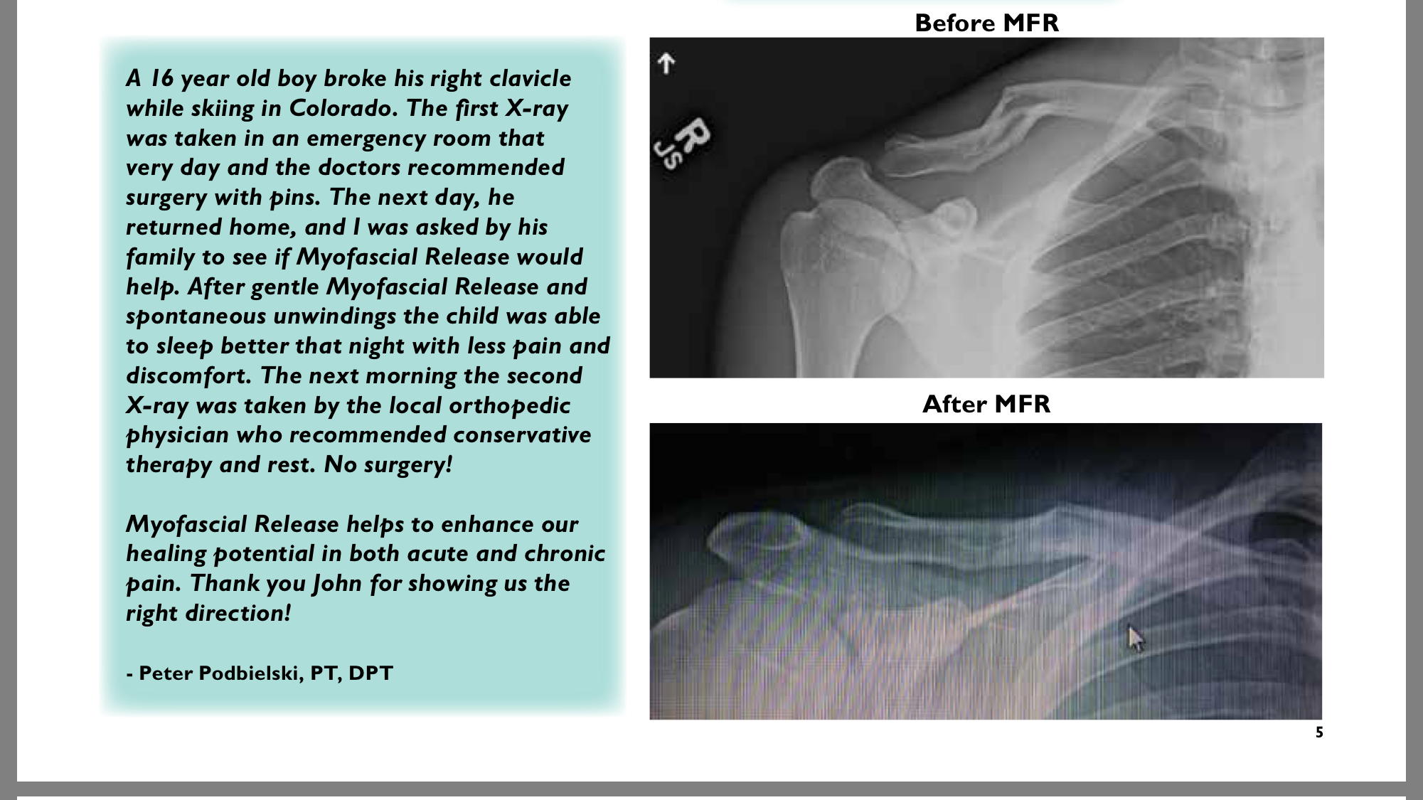 X-ray of broken clavicle day after